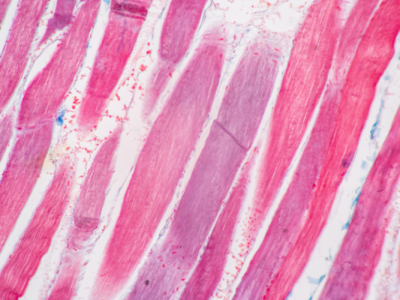 121725_Solid Biosciences Announces Duchenne Muscular Dystrophy Added to National Recommended Uniform Screening Panel by the U.S. Department of Health and Human Services (Bio Space)